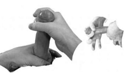 Sprain of penis da ku wê zêde bike